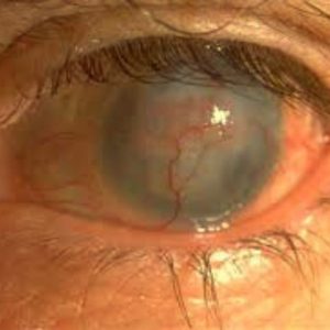 Ma Paire de lunettes - Santé visuelle - l'Herpès Oculaire