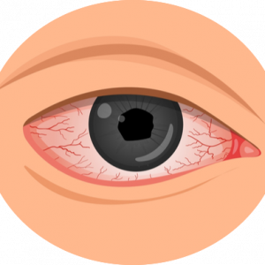 Ma Paire de lunettes - Santé visuelle - Uvéite