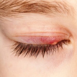 Ma Paire de lunettes - Santé visuelle - blépharite