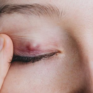 Ma Paire de lunettes - Santé visuelle - Chalazion